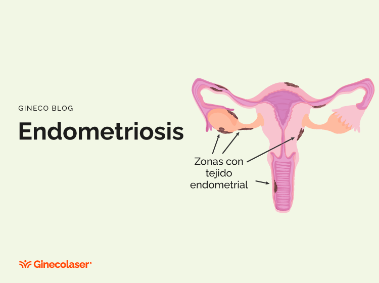 Endometriosis