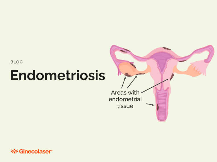 Endometriosis